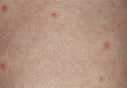 Image result for Small Red Circular Rash On Skin