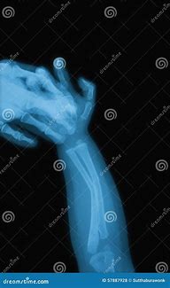 Image result for X-ray of Baby Hand