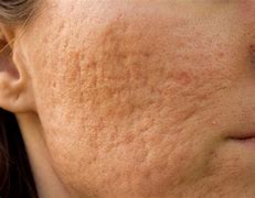 Image result for What Helps with Acne Scars