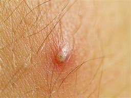 Image result for Boil vs Ingrown Hair