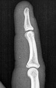 Image result for Volar Fracture