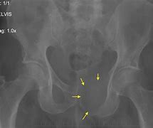 Image result for DDR and Bone Metastasis