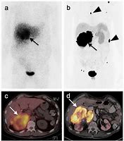 Image result for MIBG Pheochromocytoma