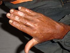 Image result for HIV Bumps On Fingers