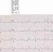 Image result for Bigeminy PVC ECG