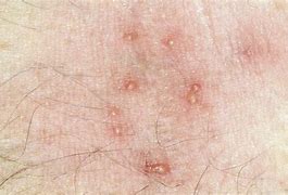 Image result for Mites On Face