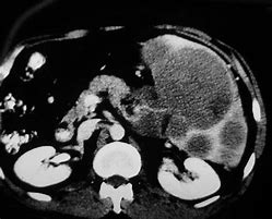 Image result for Cyst On Spleen