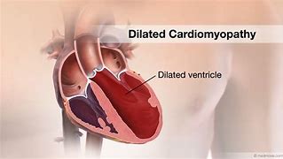 Image result for Dilated Cardiomyopathy EKG