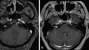 Image result for Vestibular Schwannoma Gross Pathology