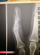 Image result for Dislocated PIP Joint in Pinky Finger