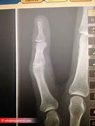 Image result for Dislocated Finger Joint