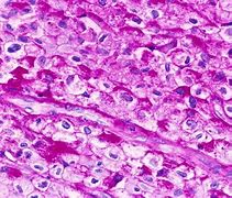 Image result for Periodic acid-Schiff Stain