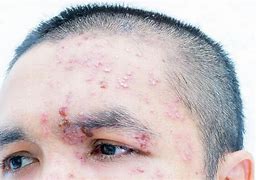 Image result for HIV Tunge