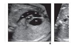 Image result for Abnormal Fetal Heart Ultrasound