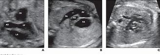 Image result for Rvot and LVOT Fetal Ultrasound Images Colour