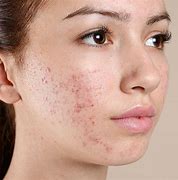 Image result for Acne On Side of Face