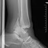 Image result for Compound Fracture Ankle Surgery