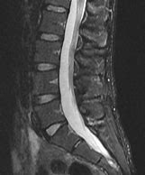 Image result for Lumbar Spine MRI 8Mm