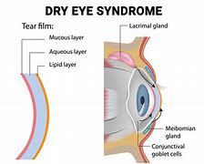 Image result for Punctal Occlusion