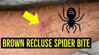 Image result for Early Spider Bite