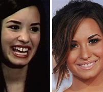 Image result for Demi Lovato Before After