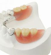 Image result for Metal-Based Partial Dentures