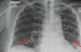 Image result for Miliary Tuberculosis Chest X-ray