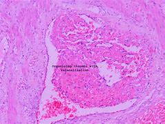 Image result for Organizing Thrombus Histology