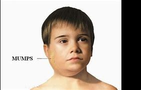 Image result for Mumps Child