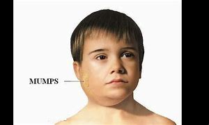 Image result for Mumps Virus