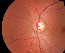 Image result for Enlarged Optic Nerve