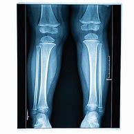 Image result for X-ray of Leg with Metal Plates