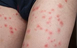 Image result for Bed Bug Bites Groin