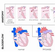 Image result for Atrial Septal Defect Blood Flow