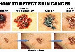 Image result for Skin Cancer On Back of Neck