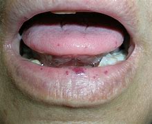 Image result for Blood Spots Under Tongue