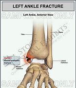 Image result for Left Lateral Malleolus Fracture