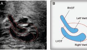 Image result for LVOT Rvot Ultrasound