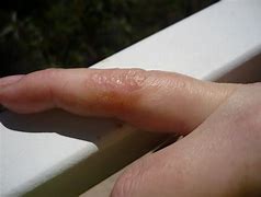 Image result for HIV Bumps On Fingers