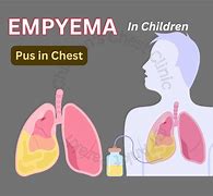 Image result for Empyema in Children Cartoon