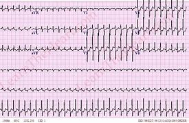 Image result for Atrioventricular Reciprocating Tachycardia