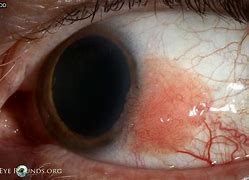 Image result for Conjunctival Papillae