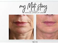 Image result for Upper Lip Wrinkles