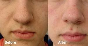 Image result for Blackhead Removal Before and After