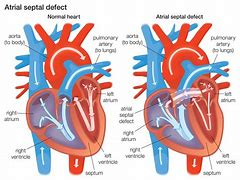 Image result for Atrial Septal Defect Blood Flow