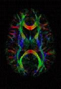 Image result for Diffusion MRI