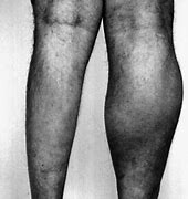 Image result for Calf Muscle Atrophy