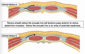 Image result for External Oblique Aponeurosis Ilio Nerve