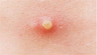 Image result for Pustule Pimple