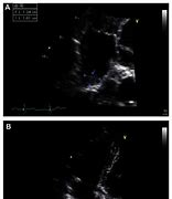 Image result for Right Atrial Thrombus Echocardiogram